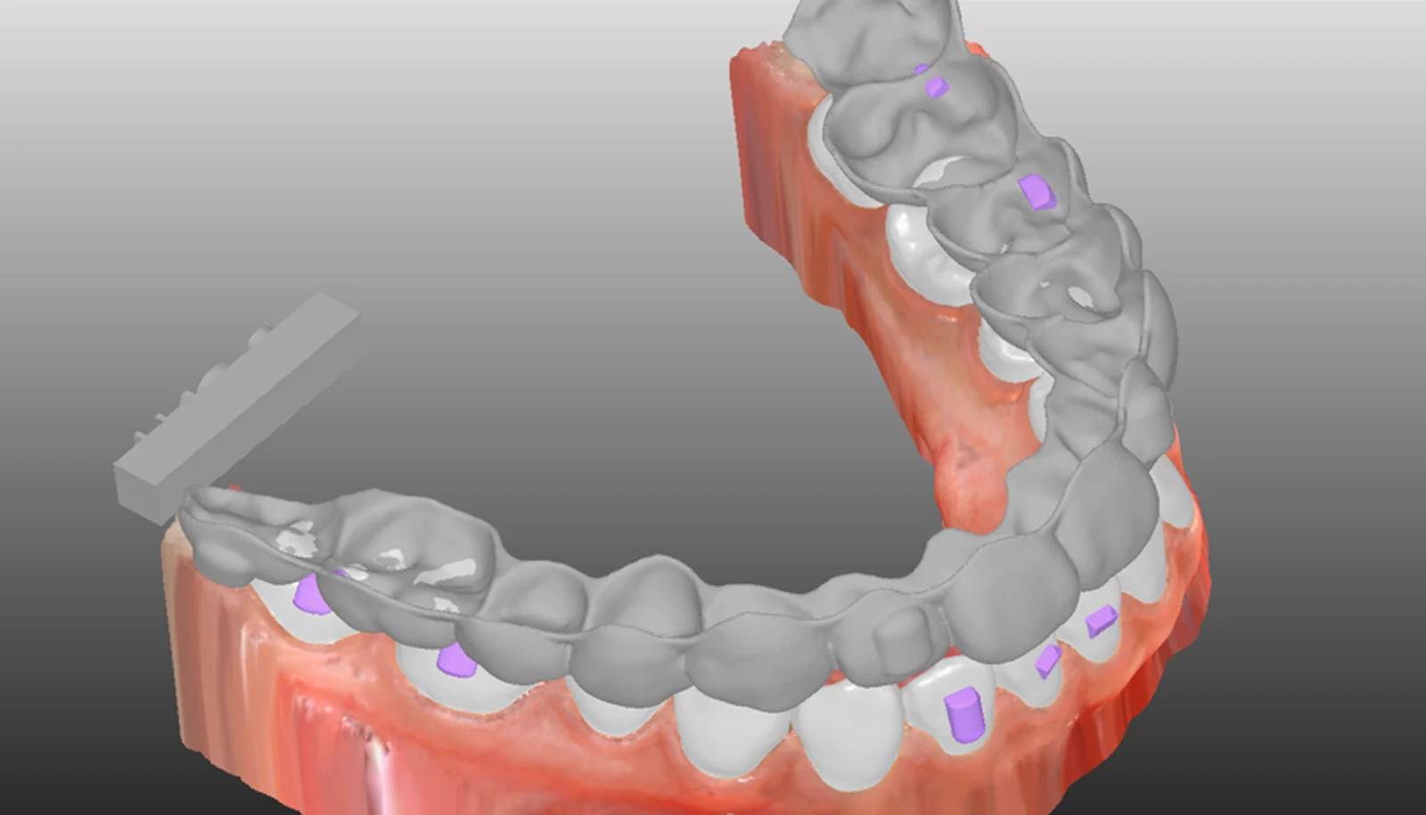 A clear aligner seated on an arch model with bonded attachments