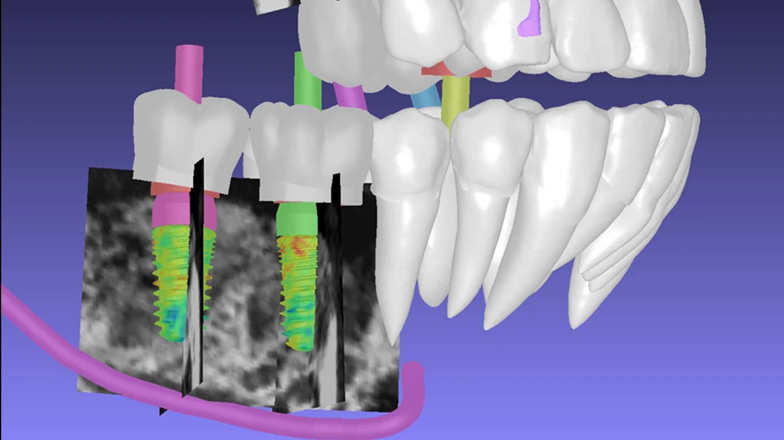 Implants colour-mapped against bone density inside CBCT slices, with tooth roots and the inferior alveolar nerve canal