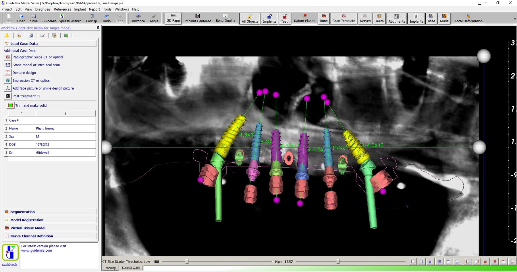 GuideMia Implant Master showing planned implants and abutments over a panoramic CBCT reconstruction with the nerve canal traced