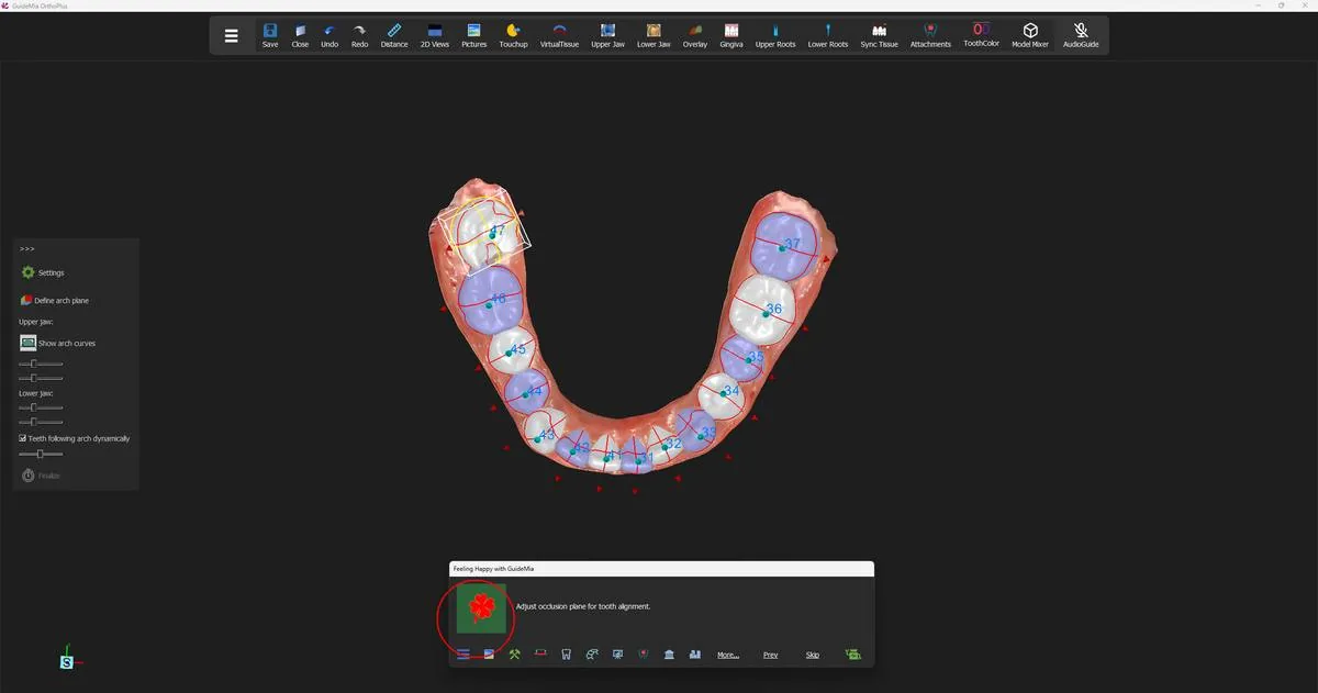 The teeth numbered and the occlusal plane brought up for a last look before alignment.
