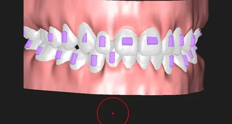 GuideMia OrthoPlus with an aligner case set up and the arch curves drawn