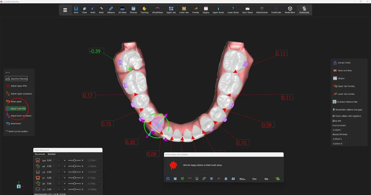 The lower arch after the first IPR pass: remaining collisions in red, a gap in green at the left molar.