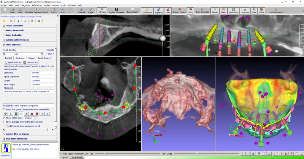 GuideMia Implant Master screenshot