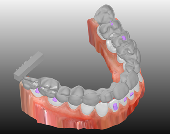 Clear-aligner planning